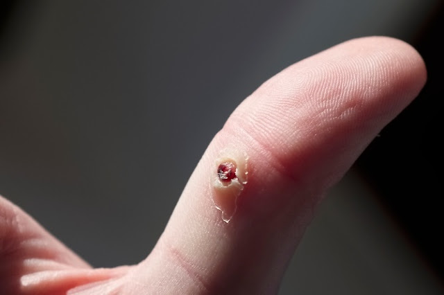 Mụn cóc (warts) là gì? nguyên nhân gây mụn cóc và chúng có nguy hiểm không